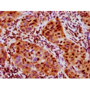 Immunohistochemistry analysis of RPS6KA5 (pS376) Antibody diluted at 1/100 and staining in paraffin-embedded human bladder cancer. After dewaxing and hydration, antigen retrieval was mediated by high pressure in a citrate buffer (pH 6.0). Section was blocked with 10% normal goat serum 30min at RT. Then primary antibody (1% BSA) was incubated at 4°C overnight. The primary is detected by a biotinylated secondary antibody and visualized using an HRP conjugated SP system.