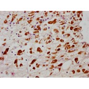 Immunohistochemistry analysis of MLKL (pS358) Antibody diluted at 1/100 and staining in paraffin-embedded human melanoma cancer. After dewaxing and hydration, antigen retrieval was mediated by high pressure in a citrate buffer (pH 6.0). Section was blocked with 10% normal goat serum 30min at RT. Then primary antibody (1% BSA) was incubated at 4°C overnight. The primary is detected by a biotinylated secondary antibody and visualized using an HRP conjugated SP system.