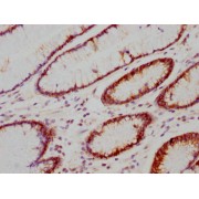 Immunocytochemistry analysis of CA9 Antibody diluted at 1/118 and staining in paraffin-embedded human gastric cancer. After dewaxing and hydration, antigen retrieval was mediated by high pressure in a citrate buffer (pH 6.0). Section was blocked with 10% normal goat serum 30min at RT. Then primary antibody (1% BSA) was incubated at 4°C overnight. The primary is detected by a biotinylated secondary antibody and visualized using an HRP conjugated SP system.