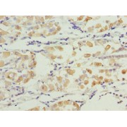 IHC-P analysis of human gastric cancer tissue, using SMG6 Antibody (1/100 dilution).