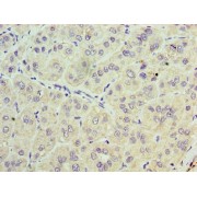 IHC-P analysis of human liver cancer tissue, using TRBC1 Antibody (1/100 dilution).