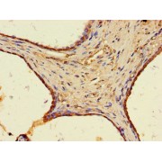 IHC-P analysis of human prostate cancer tissue, using WFDC8 antibody (1/100 dilution).