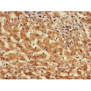 IHC-P analysis of human liver cancer tissue, using MYO7A antibody (1/100 dilution).