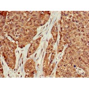IHC-P analysis of human ovarian cancer tissue, using KRAS antibody (1/100 dilution).