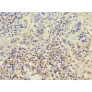 IHC-P analysis of Human bladder cancer, using EP300 antibody (1/100 dilution).