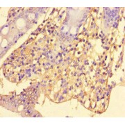 IHC-P analysis of human colon cancer tissue, using SRGAP2C antibody (1/100 dilution).