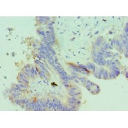 IHC-P analysis of human colon cancer tissue, using IGFBP4 antibody (1/100 dilution).