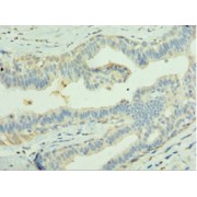 Immunohistochemistry analysis of paraffin-embedded Human breast cancer tissue using Leucine Rich Glioma Inactivated 1 (LGI1) Antibody (1/100 dilution).