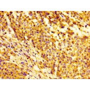 IHC-P analysis of human colon cancer  tissue using IGFBP6 Antibody (dilution 1/100).
