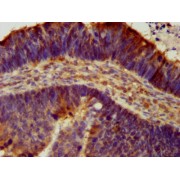 IHC-P analysis of human ovarian cancer tissue, using ASIC2 antibody (1/300 dilution).