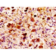 IHC-P analysis of human melanoma, using MASP2 antibody (1/100 dilution). After dewaxing and hydration, antigen retrieval was mediated by high pressure in a citrate buffer (pH 6.0). Section was blocked with 10% normal goat serum for 30 min at room temperature. The primary antibody (1% BSA) was then incubated at 4°C overnight. The primary is detected by a biotin-conjugated secondary antibody and visualized using an HRP-conjugated SP system.