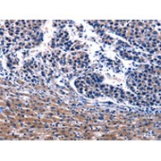 IHC-P analysis of human liver cancer tissue, using IRS4 Antibody (1/17 dilution, 200x magnification).