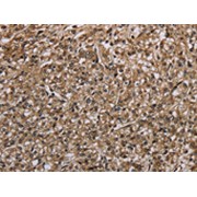 IHC-P analysis of human prostate cancer tissue, using MYO18B antibody (1/20 dilution, 200x magnification).
