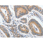 IHC-P analysis of human colon cancer tissue, using PIWIL2 antibody (1/40 dilution, 200x magnification).