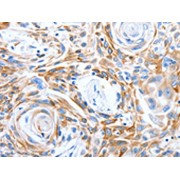 IHC-P analysis of human esophagus cancer tissue, using LRIG3 antibody (1/50 dilution, 200X magnification).