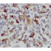 IHC-P analysis of human lung cancer tissue, using BAGE4 antibody (1/50 dilution).