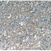IHC-P analysis of human cervical cancer tissue, using CDCA3 Antibody (1/50 dilution).