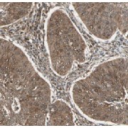 IHC-P analysis of human cervical cancer tissue FAM168B antibody (1/50 dilution).