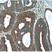 IHC-P analysis of human colon cancer tissue, using FGFBP1 antibody (1/50 dilution).