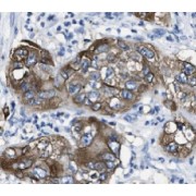 IHC-P analysis of human pancreas cancer tissue, using Hephaestin Antibody (1/50 dilution).