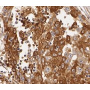 IHC-P analysis of human hepatocirrhosis tissue, using HMP19 Antibody (1/400 dilution).