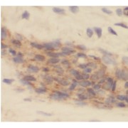 IHC-P analysis of human breast cancer tissue, using IL19 Antibody (1/50 dilution).