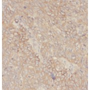 IHC-P analysis of human liver cancer tissue, using IL27 Antibody (1/50 dilution).