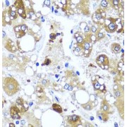 IHC analysis of paraffin-embedded human liver injury, using IL4 antibody (1/100 dilution).