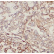 IHC-P analysis of human lung cancer tissue, using Cytokeratin 10-specific antibody (1/200 dilution).