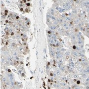 IHC-P analysis of human pancreas cancer tissue, using NCLN antibody (1/50 dilution).