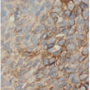 IHC-P analysis of human lung cancer tissue, using OLFM1 antibody (1/50 dilution).