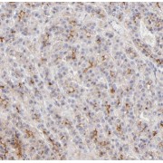 IHC-P analysis of human liver cancer tissue, using RELN antibody (1/200 dilution).