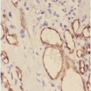 IHC-P analysis of human glioma tissue, using ROMO1 antibody (1/200 dilution).