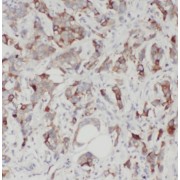 IHC-P analysis of human breast cancer tissue, using S100A14 antibody (1/200 dilution).