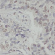 IHC-P analysis of human lung cancer tissue, using S100A16 antibody (1/200 dilution).