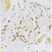 IHC analysis of paraffin-embedded human breast cancer tissue, using SNAI2 antibody (1/100 dilution).