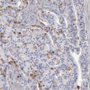 IHC-P analysis of human prostate cancer tissue, using SPON2 antibody (1/50 dilution).