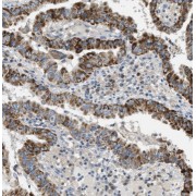 IHC-P analysis of human thyroid cancer tissue, using Thyroglobulin antibody (1/200 dilution).