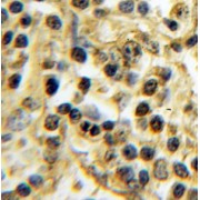 IHC-P analysis of human lymphoma tissue, using TXK antibody (1/100 dilution).