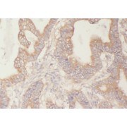 IHC-P analysis of human colon cancer tissue, using YWHAB antibody (1/50 dilution).