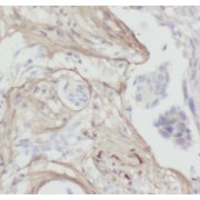 IHC-P analysis of human breast cancer tissue, using COL1A2 antibody (1/5000 dilution).