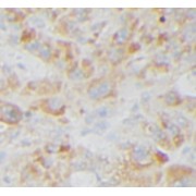IHC-P analysis of human liver cancer tissue, using PGBM antibody (1/10 dilution).