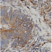IHC-P analysis of human colon cancer tissue, using DFB14 antibody (1/200 dilution).
