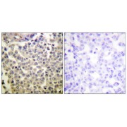 Immunohistochemistry analysis of paraffin-embedded human breast carcinoma tissue using PAK1/2/3 (Phospho-Thr423/402/421) antibody.