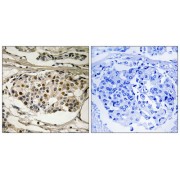 Immunohistochemistry analysis of paraffin-embedded human breast carcinoma tissue, using NF-kB p65 (Phospho-Ser281) antibody.