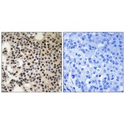 Immunohistochemistry analysis of paraffin-embedded human breast carcinoma tissue using PAK2 (Phospho-Ser197) antibody.