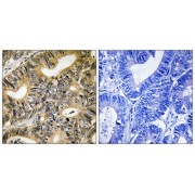 Immunohistochemistry analysis of paraffin-embedded human colon carcinoma tissue using 4E-BP1 (Phospho-Thr70) antibody.