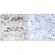 Immunohistochemistry analysis of paraffin-embedded human breast carcinoma tissue, using Estrogen Receptor- alpha (Phospho-Ser102) antibody.