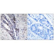 Immunohistochemistry analysis of paraffin-embedded human colon carcinoma tissue using Histone H2A antibody.