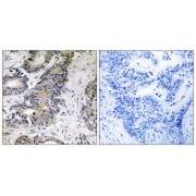 Immunohistochemistry analysis of paraffin-embedded human colon carcinoma tissue using 4E-BP1 antibody.
